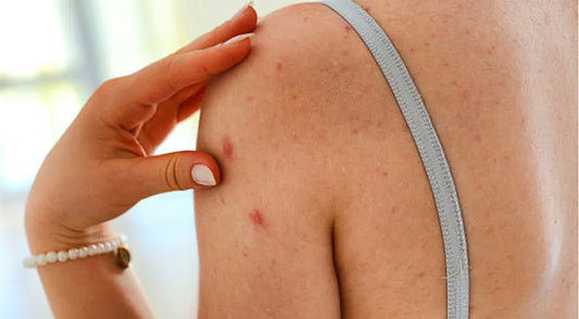 Light Therapy for Melasma: The Role of LED Face Masks