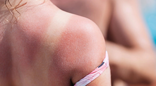 UV DNA Damage: Why Skin Type & Age Matter