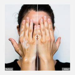 ZJZK Portable 308nm Excimer UVB Light- Vitiligo/Psoriasis Light Therapy Device