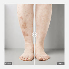 ZJZK Portable 308nm Excimer UVB Light- Vitiligo/Psoriasis Light Therapy Device